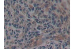 Detection of MAPT in Human Lung cancer Tissue using Polyclonal Antibody to Tau Protein (MAPT)
