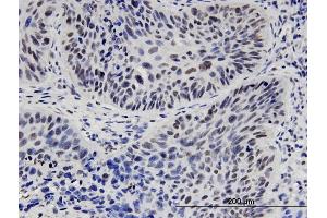 Immunoperoxidase of monoclonal antibody to HNF1B on formalin-fixed paraffin-embedded human lung adenocarcinoma. (HNF1B Antikörper  (AA 29-118))