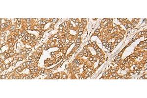 Immunohistochemistry of paraffin-embedded Human liver cancer tissue using GNB1L Polyclonal Antibody at dilution of 1:35(x200)