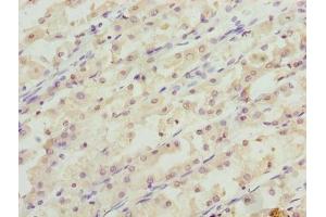 Immunohistochemistry of paraffin-embedded human gastric cancer using ABIN7166006 at dilution of 1:100 (RER1 Antikörper  (AA 85-139))