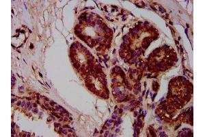 IHC image of ABIN7168291 diluted at 1:400 and staining in paraffin-embedded human breast cancer performed on a Leica BondTM system. (MOV10L1 Antikörper  (AA 336-425))