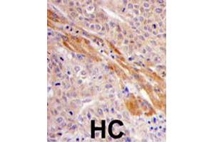Formalin-fixed and paraffin-embedded human hepatocellular carcinoma reacted with PGK1 polyclonal antibody  , which was peroxidase-conjugated to the secondary antibody, followed by DAB staining. (PGK1 Antikörper  (Internal Region))