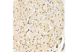 Immunohistochemistry of paraffin-embedded human gastric cancer using TERF1 antibody. (TRF1 Antikörper)