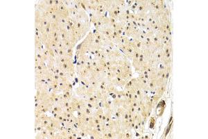 Immunohistochemistry of paraffin-embedded human gastric cancer using TERF1 antibody. (TRF1 Antikörper)