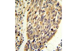 Formalin fixed, paraffin embedded human lung carcinoma stained with KM2 Antibody (N-term) followed by peroxidase conjugation of the secondary antibody and DAB staining. (PKM2 Antikörper  (N-Term))