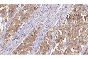 ABIN6275304 at 1/100 staining Human Melanoma tissue by IHC-P. (Neuromedin U Antikörper  (C-Term))