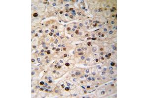 Formalin-fixed and paraffin-embedded human hepatocarcinoma tissue reacted with PCNA antibody (Center) (ABIN389345 and ABIN2839454) , which was peroxidase-conjugated to the secondary antibody, followed by DAB staining. (PCNA Antikörper  (AA 89-117))
