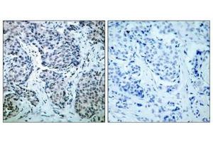 Immunohistochemical analysis of paraffin-embedded human breast carcinoma tissue using SEK1/MKK4(Phospho-Thr261) Antibody(left) or the same antibody preincubated with blocking peptide(right). (MAP2K4 Antikörper  (pThr261))