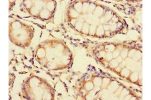 Immunohistochemistry of paraffin-embedded human colon cancer using ABIN7154300 at dilution of 1:100 (GOLPH3L Antikörper  (AA 6-285))