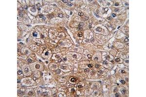 IHC analysis of FFPE human hepatocarcinoma tissue stained with BMPR2 antibody (BMPR2 Antikörper  (AA 28-59))
