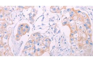 Immunohistochemistry of paraffin-embedded Human breast cancer tissue using ADAMTS14 Polyclonal Antibody at dilution 1:50 (ADAMTS14 Antikörper)
