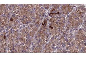 ABIN6273987 at 1/100 staining Human liver cancer tissue by IHC-P. (OR3A1 Antikörper)