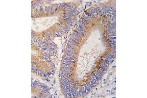 Formalin-fixed and paraffin-embedded human colon carcinoma tissue reacted with GDF11 antibody (N-term) (ABIN388814 and ABIN2839133) , which was peroxidase-conjugated to the secondary antibody, followed by DAB staining.