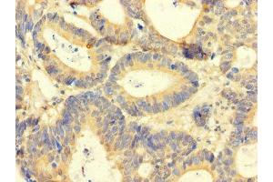 Immunohistochemistry of paraffin-embedded human colon cancer using ABIN7144028 at dilution of 1:100 (Amphiregulin Antikörper  (AA 107-148))