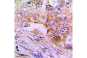 Immunohistochemical analysis of Caspase 6 p18 staining in human lung cancer formalin fixed paraffin embedded tissue section. (Caspase 6 p18 (Center) Antikörper)