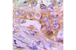Immunohistochemical analysis of Caspase 6 p18 staining in human lung cancer formalin fixed paraffin embedded tissue section. (Caspase 6 p18 (Center) Antikörper)