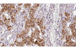 ABIN6278946 at 1/100 staining Human liver cancer tissue by IHC-P. (PLCH2 Antikörper  (N-Term))