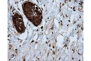 Immunohistochemical staining of paraffin-embedded Adenocarcinoma of colon tissue using anti-ACLY mouse monoclonal antibody.