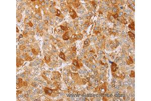 Immunohistochemistry of Human liver cancer using MCM5 Polyclonal Antibody at dilution of 1:40 (MCM5 Antikörper)
