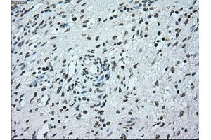Immunohistochemical staining of paraffin-embedded Adenocarcinoma of breast tissue using anti-BRAF mouse monoclonal antibody. (BRAF Antikörper)