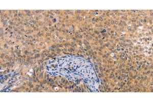 Immunohistochemistry of paraffin-embedded Human cervical cancer tissue using pVHL Polyclonal Antibody at dilution 1:40 (VHL Antikörper)