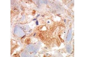 cKit antibody was used in immunohistochemistry on breast carcinoma. (KIT Antikörper  (AA 9-40))