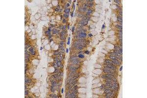 Immunohistochemistry of paraffin-embedded human rectal cancer using MMP25 antibody (ABIN5971552) at dilution of 1/200 (40x lens). (MMP25 Antikörper)