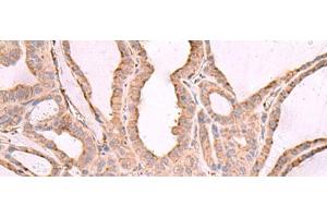 Immunohistochemistry of paraffin-embedded Human thyroid cancer tissue using EEF1D Polyclonal Antibody at dilution of 1:65(x200) (EEF1D Antikörper)
