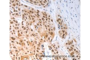 Immunohistochemistry of Human esophagus cancer using SLC22A8 Polyclonal Antibody at dilution of 1:70 (SLC22A8 Antikörper)