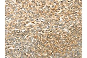The image on the left is immunohistochemistry of paraffin-embedded Human ovarian cancer tissue using ABIN7130225(MGEA5 Antibody) at dilution 1/20, on the right is treated with fusion protein. (MGEA5 Antikörper)