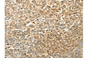 The image on the left is immunohistochemistry of paraffin-embedded Human ovarian cancer tissue using ABIN7130225(MGEA5 Antibody) at dilution 1/20, on the right is treated with fusion protein.