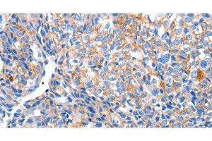 Immunohistochemistry of paraffin-embedded Human breast cancer tissue using HCN2 Polyclonal Antibody at dilution 1:80 (HCN2 Antikörper)
