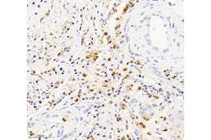 Immunohistochemistry analysis of paraffin-embedded human squamous carcinoma of the cervix using S100A12 (ABIN7075493) at dilution of 1: 4000 (S100A12 Antikörper)