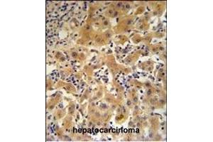 CP Antibody (N-term) (ABIN391512 and ABIN2841473) IHC analysis in formalin fixed and paraffin embedded human hepatocarcinoma followed by peroxidase conjugation of the secondary antibody and DAB staining. (Ceruloplasmin Antikörper  (N-Term))