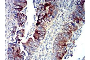 Immunohistochemical analysis of paraffin-embedded rectum cancer tissues using P2RY14 mouse mAb with DAB staining. (P2RY14 Antikörper)