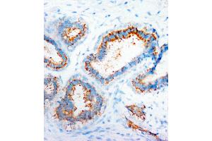 Anti-CXCR4 antibody, IHC(P) IHC(P): Human Mammary Cancer Tissue