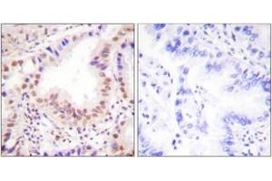 Immunohistochemistry analysis of paraffin-embedded human lung carcinoma tissue, using ETS1 (Ab-38) Antibody. (ETS1 Antikörper  (AA 11-60))