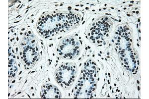 Immunohistochemical staining of paraffin-embedded breast tissue using anti-BRAF mouse monoclonal antibody. (BRAF Antikörper)