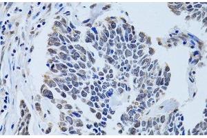 Immunohistochemistry of paraffin-embedded Human lung cancer using SIN3A Polyclonal Antibody at dilution of 1:100 (40x lens). (SIN3A Antikörper)