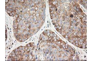 Immunohistochemical staining of paraffin-embedded Adenocarcinoma of Human breast tissue using anti-TUBB4 mouse monoclonal antibody. (TUBB4 Antikörper)