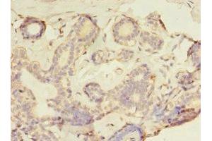 Immunohistochemistry of paraffin-embedded human breast cancer using ABIN7153932 at dilution of 1:100 (GFOD2 Antikörper  (AA 1-280))
