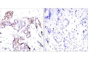 Immunohistochemical analysis of paraffin-embedded human breast carcinoma tissue using Elk-1 (phospho-Ser389) antibody (E011037). (ELK1 Antikörper  (pSer389))