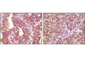Immunohistochemical analysis of paraffin-embedded human bladder carcinoma tissue(left) and lung carcinoma tissue (right) showing cytoplasmic localization using BRAF antibody with DAB staining. (BRAF Antikörper)