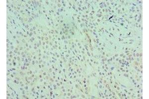 Immunohistochemistry of paraffin-embedded human breast cancer using ABIN7168966 at dilution of 1:100 (SRSF1 Antikörper  (AA 1-248))