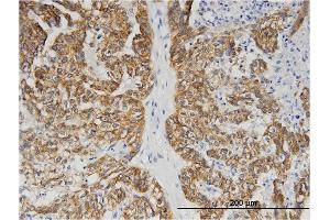 Immunoperoxidase of monoclonal antibody to BAIAP2L1 on formalin-fixed paraffin-embedded human ovarian cancer. (BAIAP2L1 Antikörper  (AA 1-511))