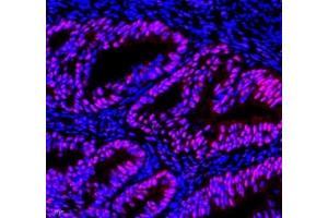 Immunofluorescence of paraffin embedded human ovarian cancer using EFTUD2 (ABIN7073810) at dilution of 1: 2400 (400x lens) (EFTUD2 Antikörper)