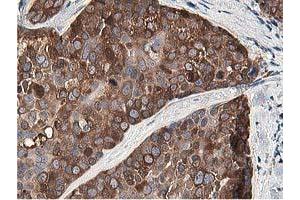 Immunohistochemical staining of paraffin-embedded Adenocarcinoma of Human breast tissue using anti-OSBP mouse monoclonal antibody. (OSBP Antikörper)