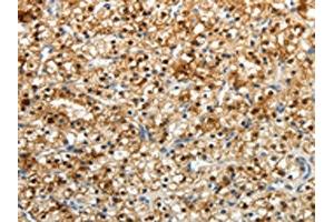 The image on the left is immunohistochemistry of paraffin-embedded Human renal cancer tissue using ABIN7190724(FZD2 Antibody) at dilution 1/25, on the right is treated with synthetic peptide. (FZD2 Antikörper)