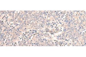 Immunohistochemistry of paraffin-embedded Human cervical cancer tissue using EMX1 Polyclonal Antibody at dilution of 1:25(x200) (EMX1 Antikörper)