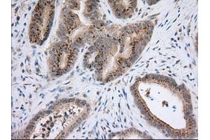 Immunohistochemical staining of paraffin-embedded Adenocarcinoma of Human colon tissue using anti-NXNL2 mouse monoclonal antibody.